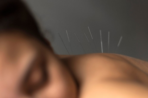 Acupuncture needles strategically placed to enhance fertility by improving blood flow to reproductive organs.